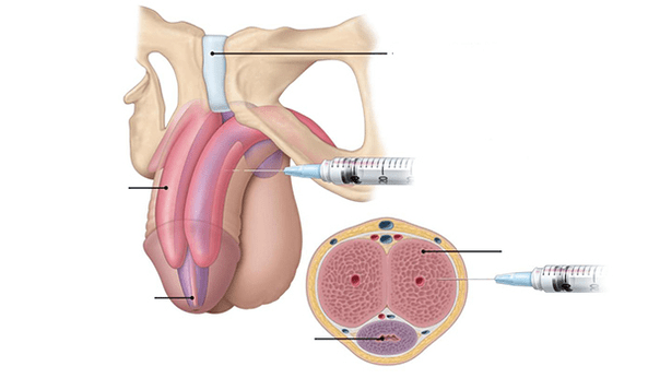 injection of your own adipose tissue to increase penis thickness