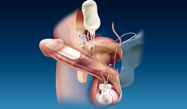 thick silicone and gel fillers